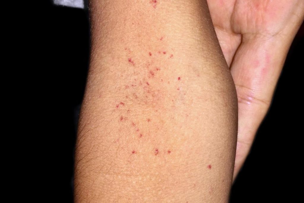 qual o sintoma da dengue: sintoma de dengue